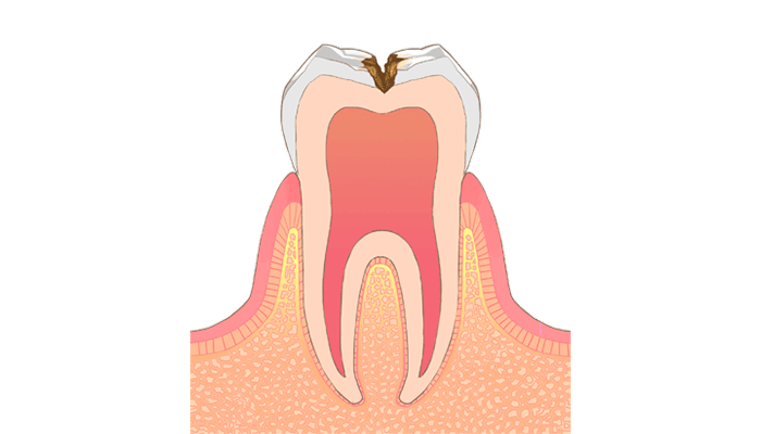 C2：象牙質に達した虫歯