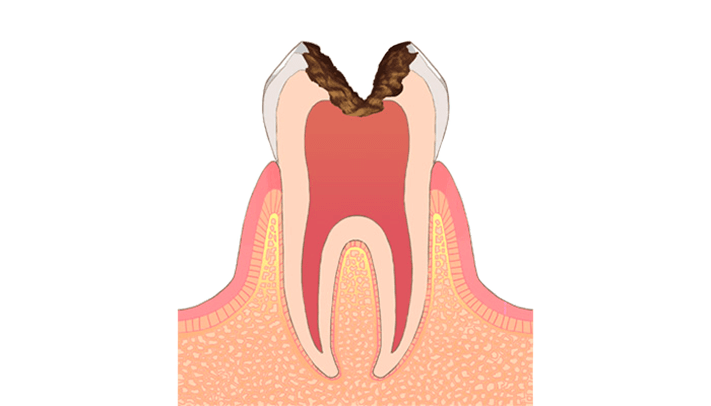 C3：歯髄(神経)に達した虫歯